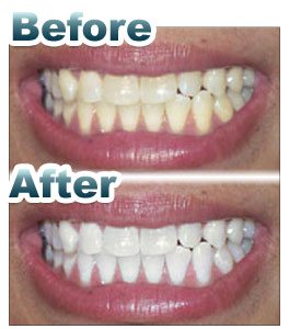 DaVinci Teeth Whitening of Rockford